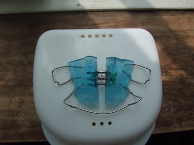 歯科矯正 9ヶ月目